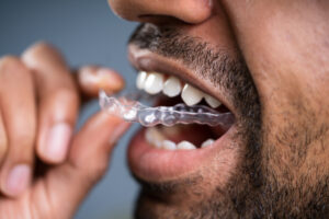 Ortodonzia trasparente per adulti