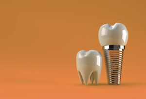 Quanto dura un impianto dentale