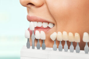 Quanto durano le faccette dentali