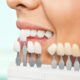 Quanto durano le faccette dentali