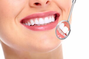 Come mettere le faccette dentali