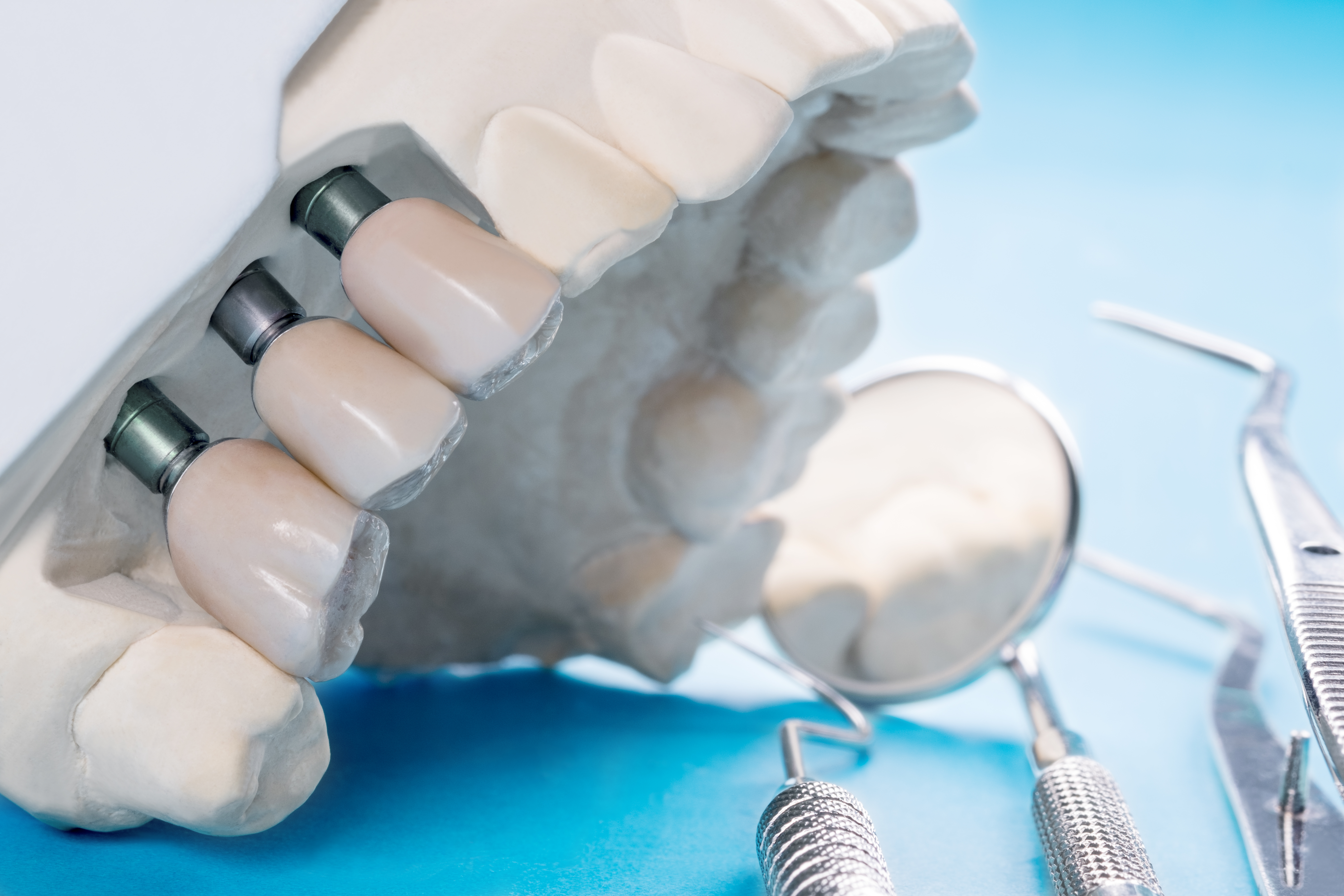 cosa mangiare dopo impianto dentale