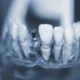 Come avviene un impianto dentale