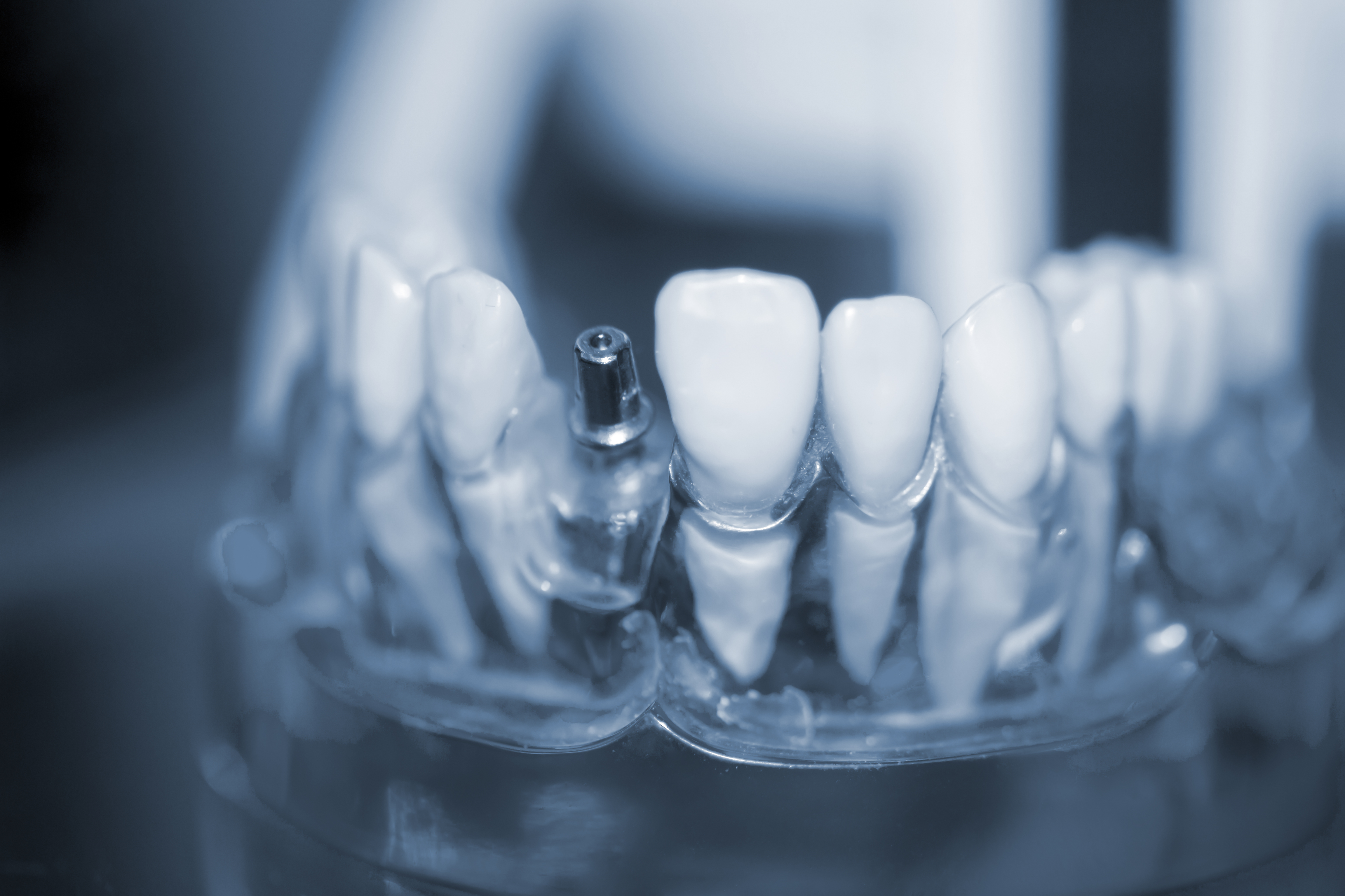 Come avviene un impianto dentale