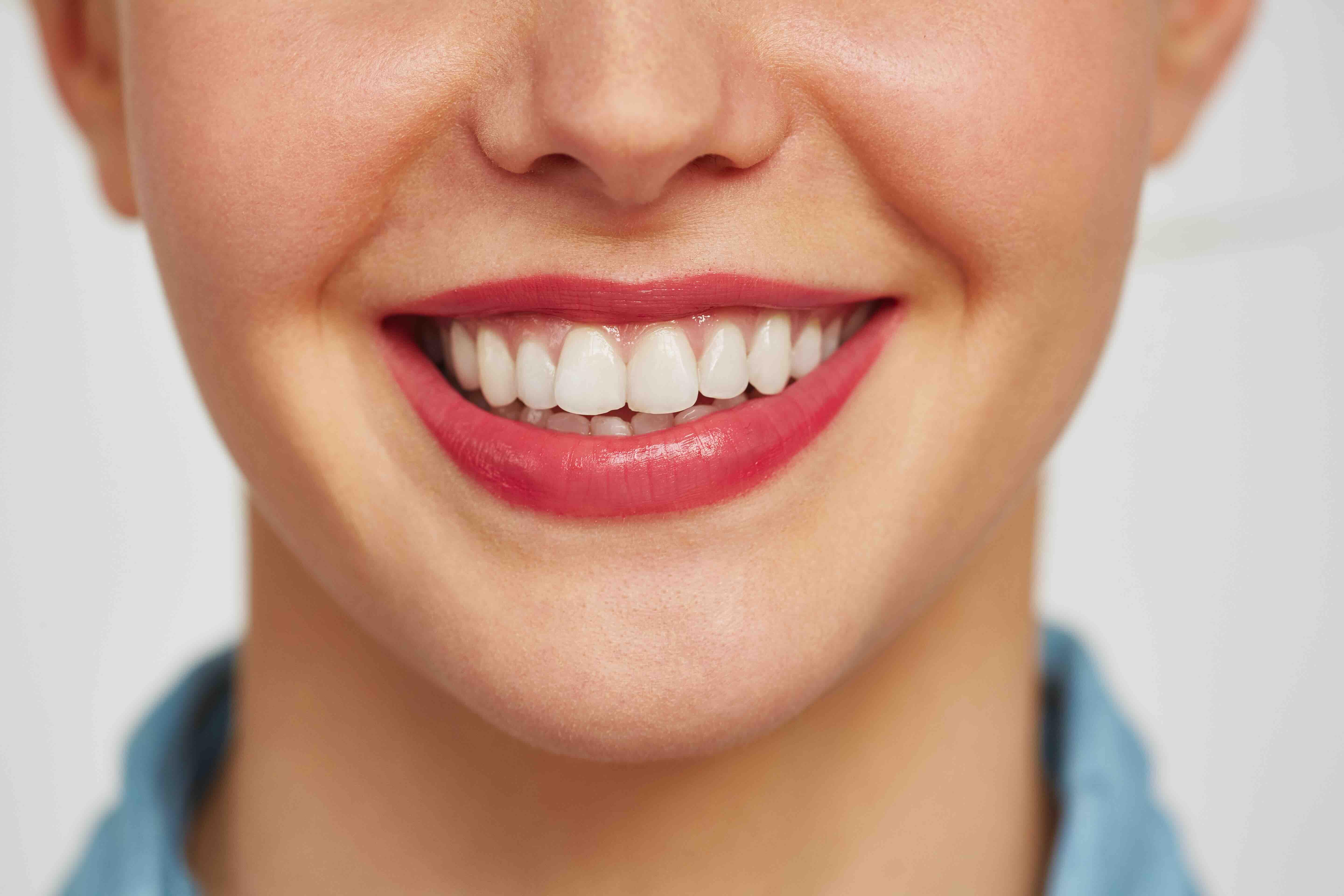 Faccette dentali