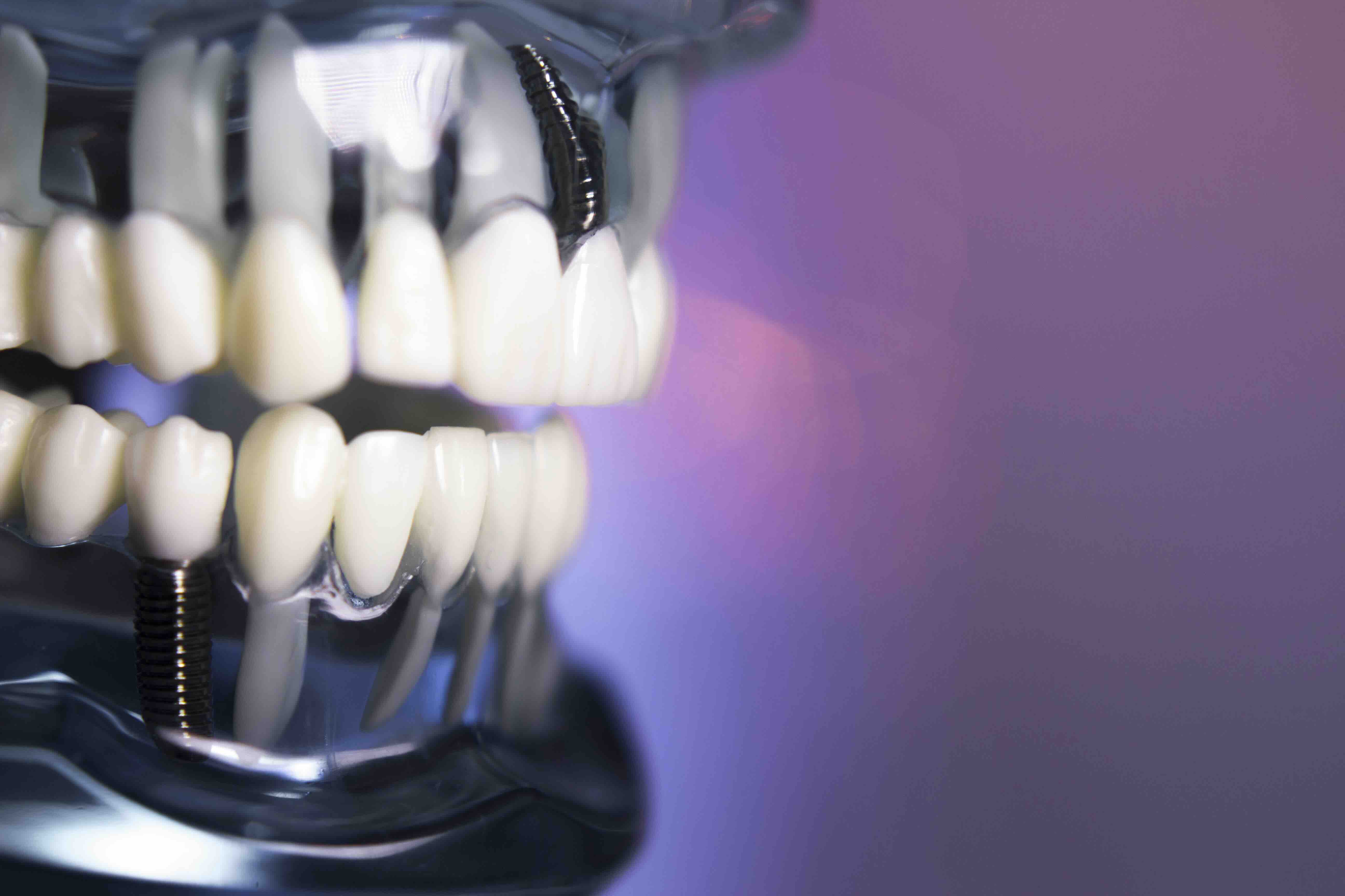 Cosa non fare dopo impianto dentale