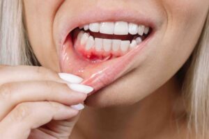 Come prevenire la parodontite