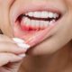 Come prevenire la parodontite