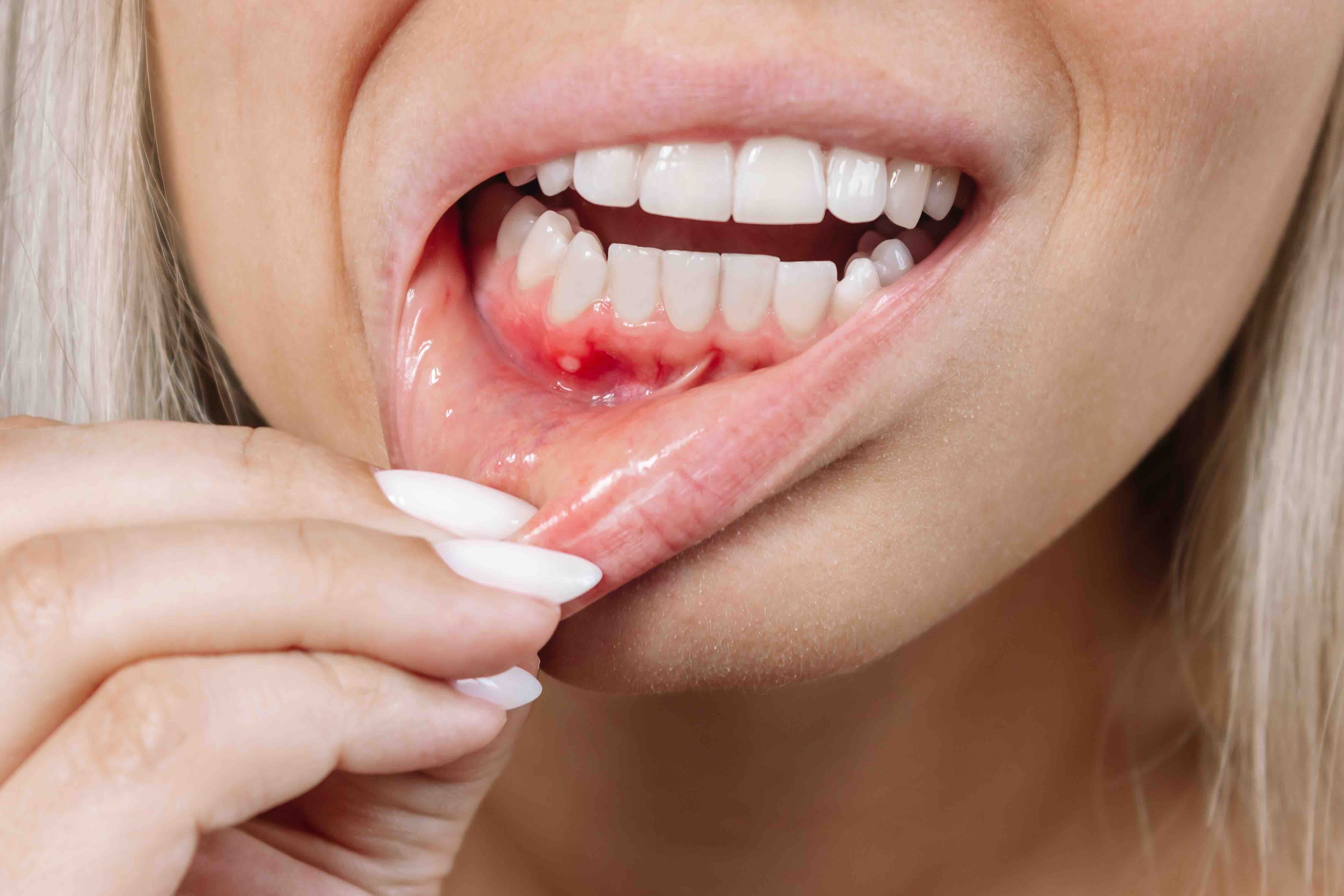 Come prevenire la parodontite