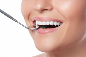 Come si mettono le faccette dentali
