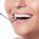 Come si mettono le faccette dentali