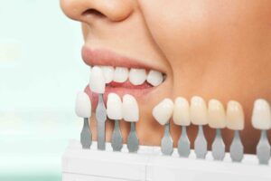 Faccette dentali e cibi