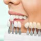 Faccette dentali e cibi