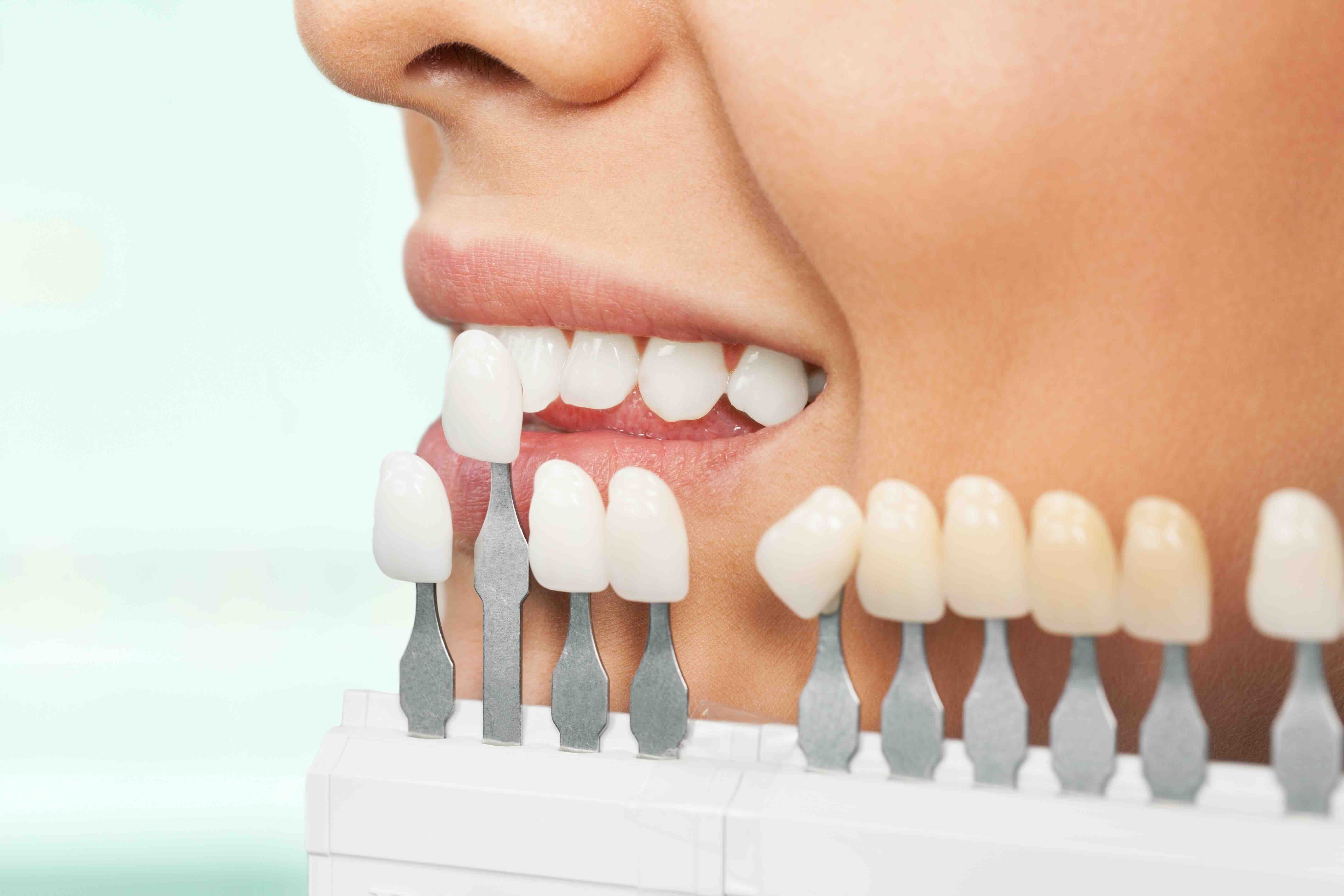 Faccette dentali e cibi