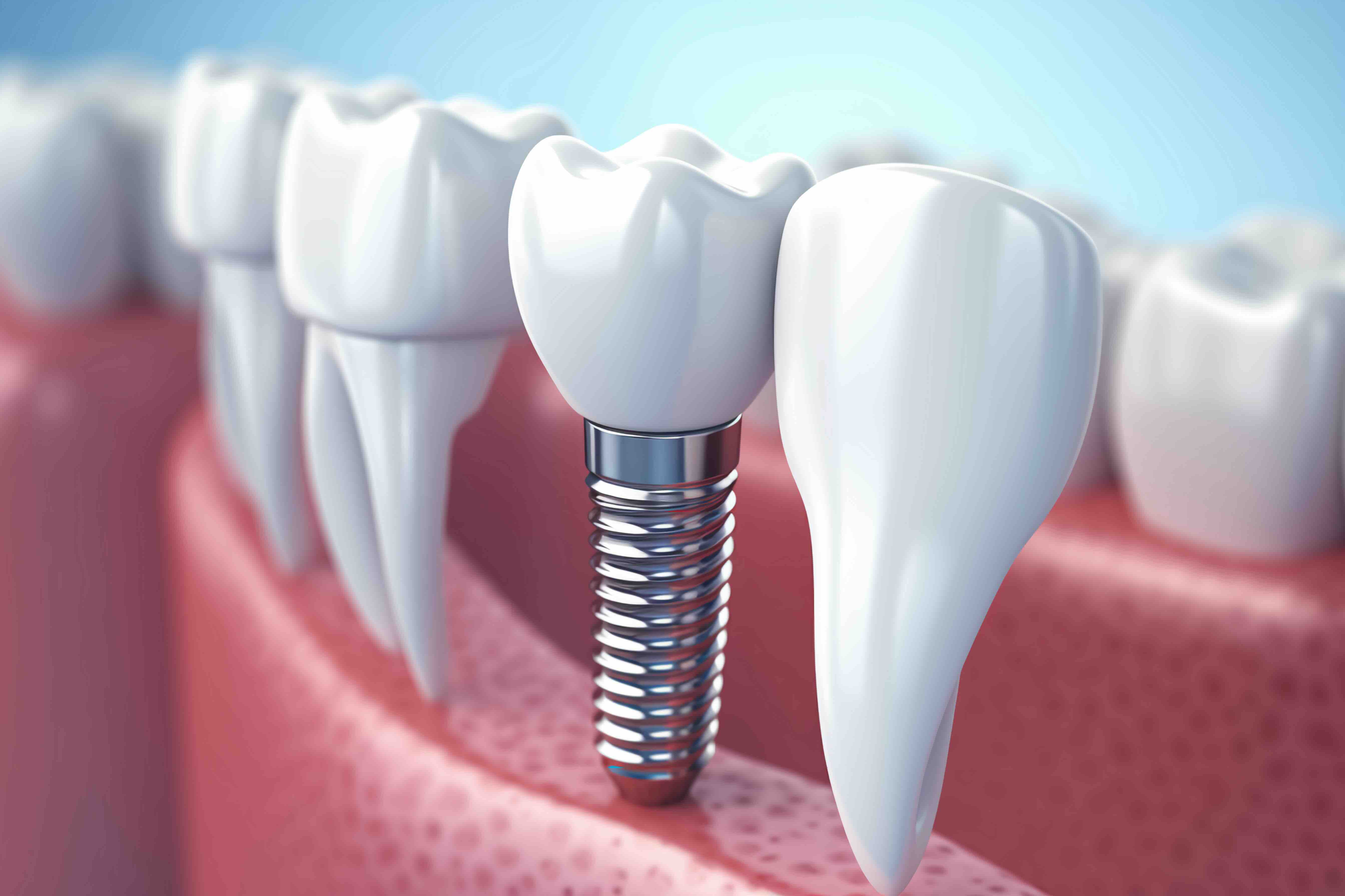 Come funziona impianto dentale