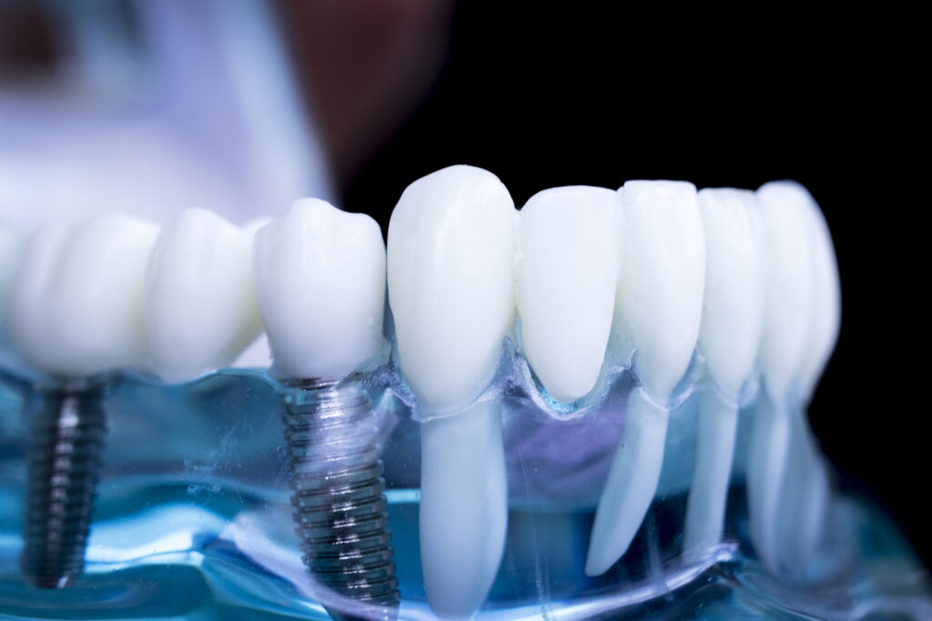 quanto dura un impianto dentale