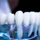 Quanto dura un impianto dentale