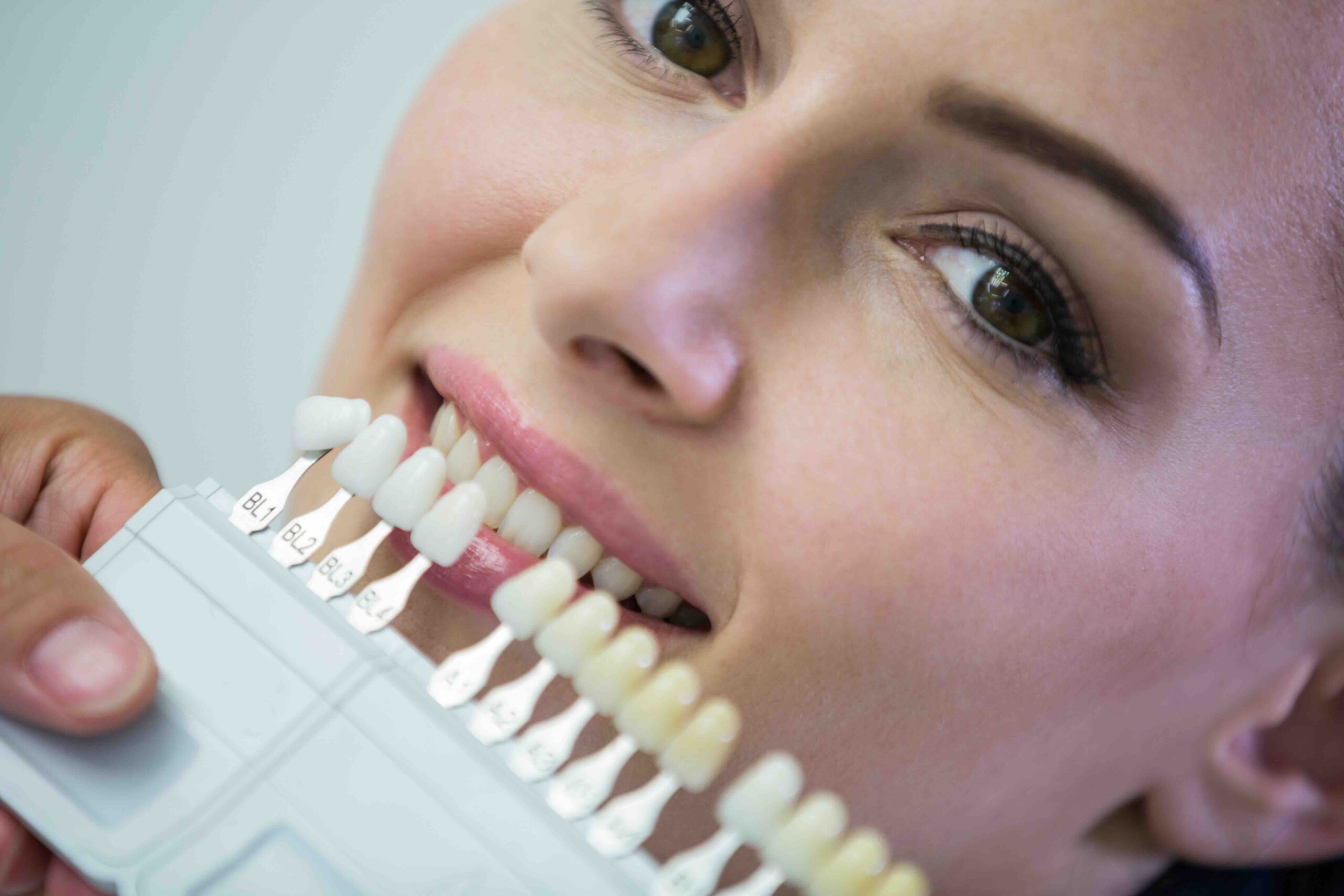 faccette dentali e costi nascosti